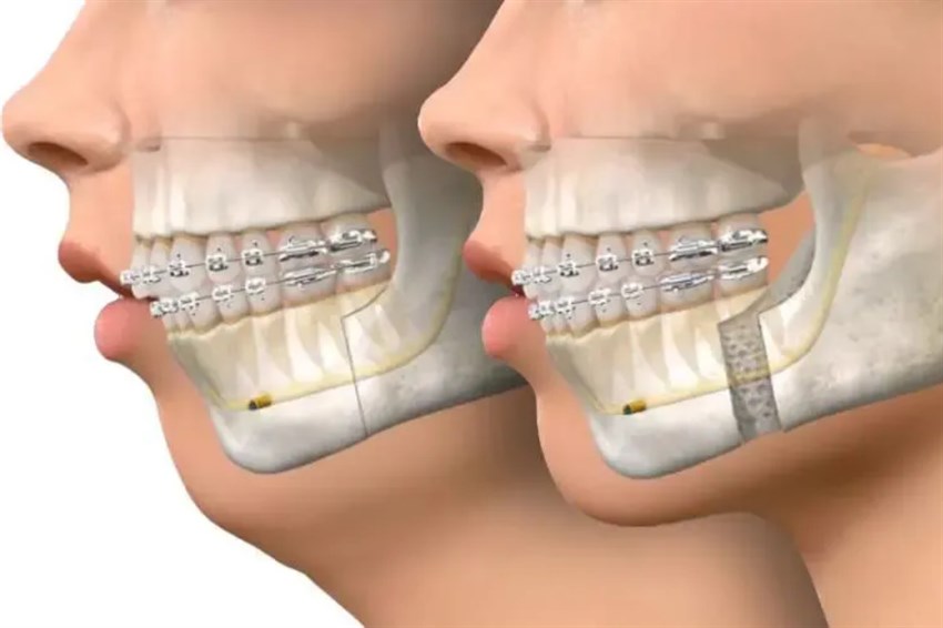 همه چیز درباره جراحی ارتوگناتیک: عملکرد، مزایا و مراقبت‌ها