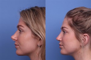 پرزرویشن رینوپلاستی چیست؟ مزایا، روش انجام و عوارض