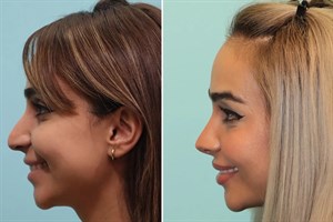 عوارض جراحی بینی ثانویه: چه مشکلاتی ممکن است رخ دهد؟